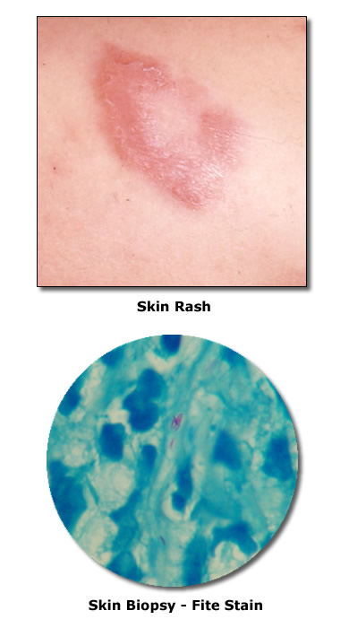 Rash and Skin Biopsy