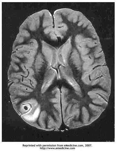 Brain Lesion
